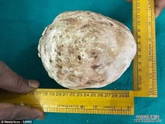 印度男子腹痛入院 膀胱取出1.5公斤巨型结石(图